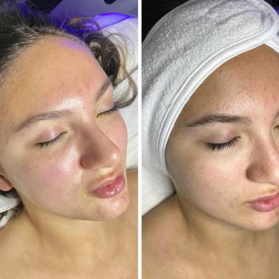 CHEMICAL PEELS